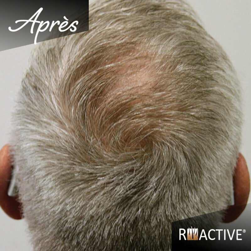 Case study baldness vertex hair growth