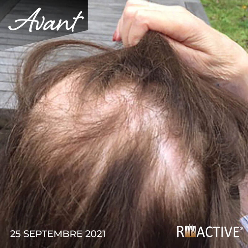 Résultat avant et après cliente satisfaite R-Active cheveux qui repousse, traitement alopécie